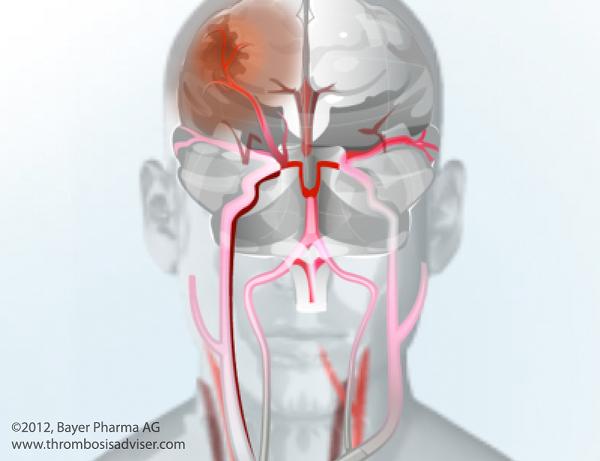 ischemia-stroke-embolus-illustration-HR
